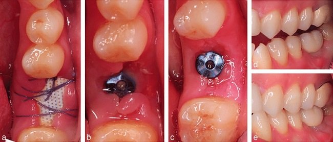 How long does a dental implant take